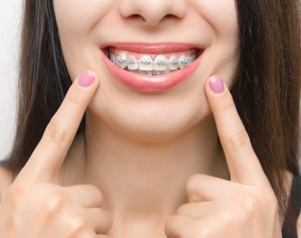 Dental braces in happy womans mouths who shows by two fingers on brackets on the teeth after whitening. Self-ligating brackets with metal ties and gray elastics or rubber bands for perfect smile. Orthodontic teeth treatment